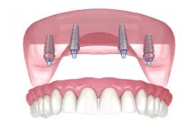 Stubbs Dental Lehi: How Do All-on-Four Implants Work?