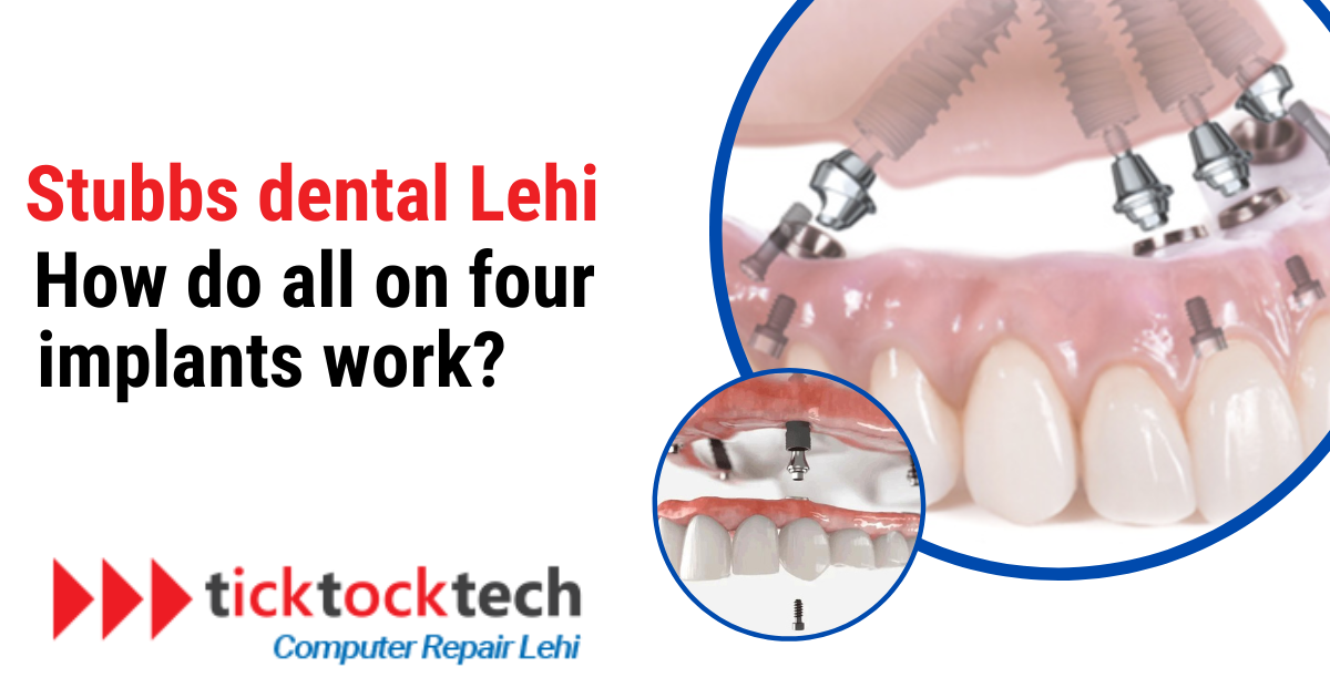 Stubbs Dental Lehi: How Do All-on-Four Implants Work?
